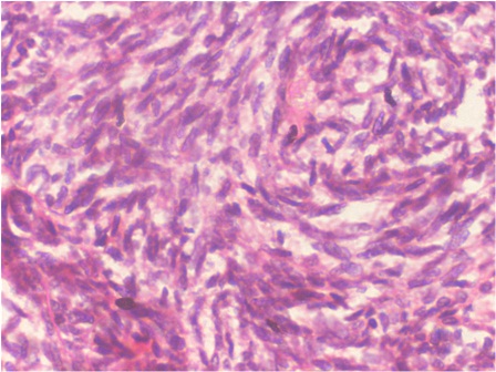 Figure 5: Photomicrograph showing the tumor cells invading the fibrous stroma, and exhibiting cytologic atypia. (H & E, 40x).
